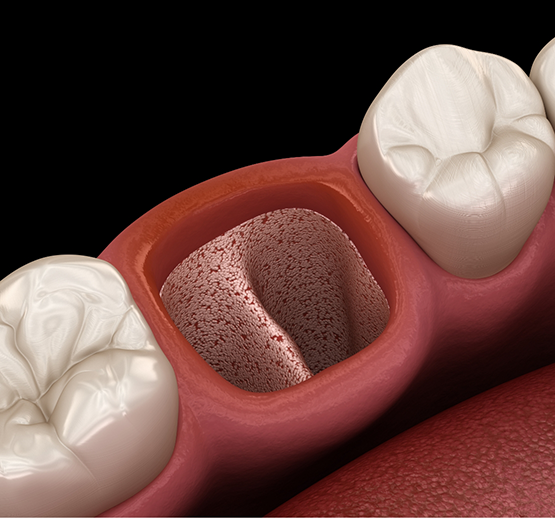 Illustration of empty socket after tooth extraction in Midlothian