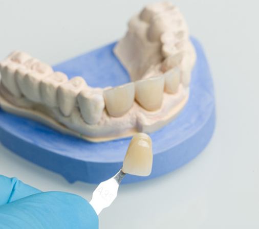 dentist placing a porcelain veneers on a model of a mouth