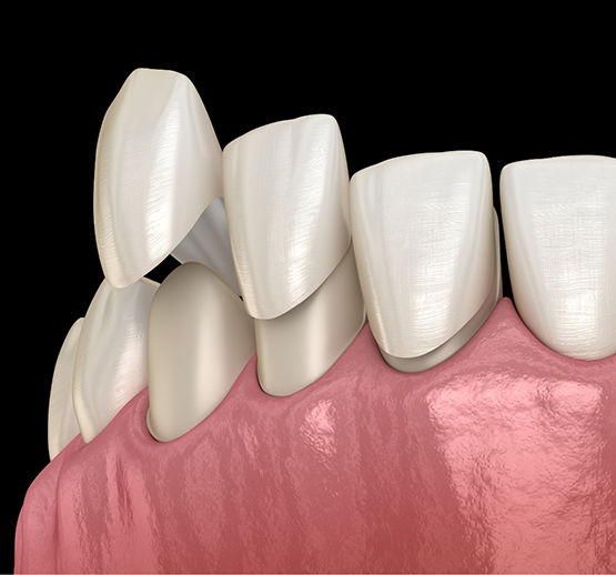 Illustration of veneers in Midlothian being attached to teeth