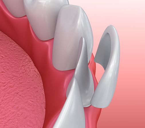 Diagram showing how veneers in Midlothian work